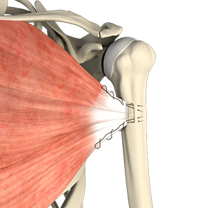 Pectoralis Major Tears/Repairs 