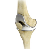 Total Knee Replacementt