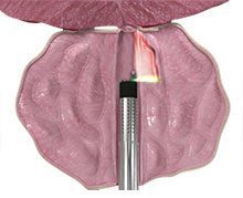 Laser BPH surgery