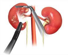 Robotic Partial Nephrectomy
