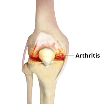 Knee Arthritis
