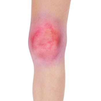 Knee Effusion
