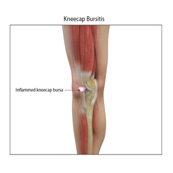 Kneecap Bursitis