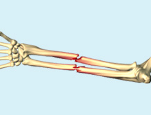 Adult Forearm Fractures