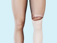 Amputation