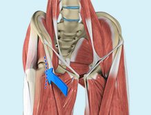 Anterior Hip Replacement