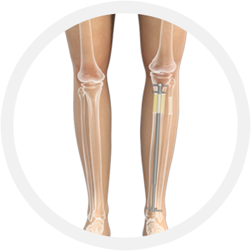 Deformity Correction