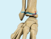 Growth Plate Injuries