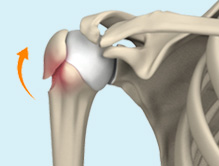 Malunion & Nonunion Fractures