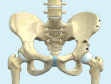 Periacetabular Osteotomy