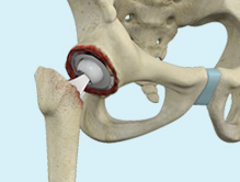 Revision Hip Replacement