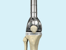 Traumatic Limb Salvage Surgery