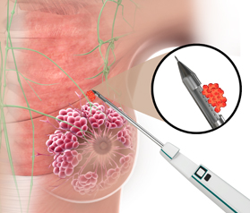 BREAST BIOPSY