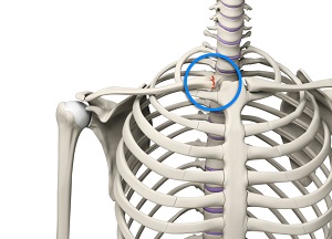 Sternoclavicular Separation