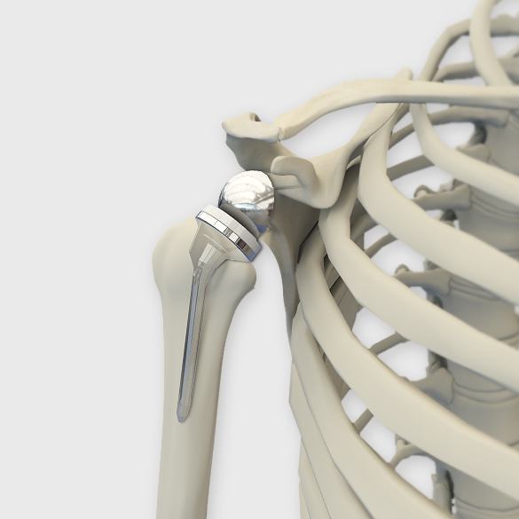 Reverse Shoulder Replacement