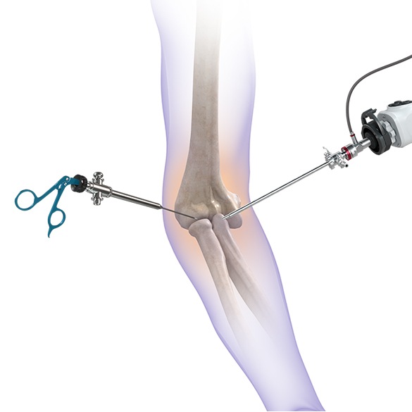Arthroscopy