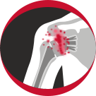 Periprosthetic Shoulder Infection