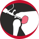 Shoulder Stabilization