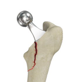 Femur Fracture