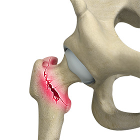 Hip fracture