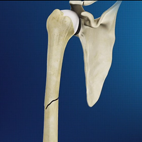 Mid Humeral Fracture