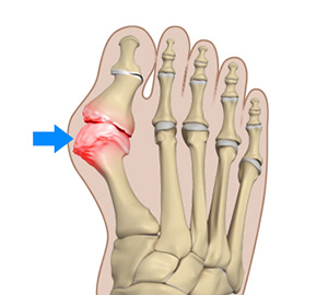 Bunion foot ankle