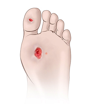Diabetic Foot Conditions