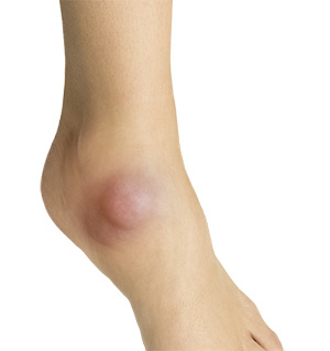 Ganglion and Soft Tissue Tumors