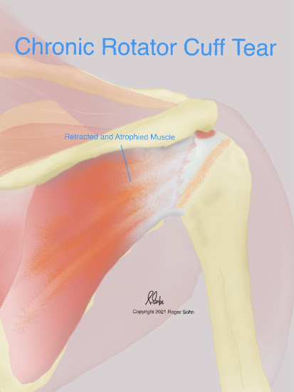 Bilateral rotator cuff clearance tear