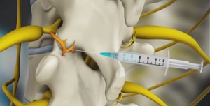 Medial Branch Block Injections