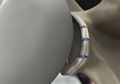 Anterior Shoulder Stabilization