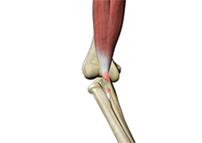 Biceps Tendon Repair