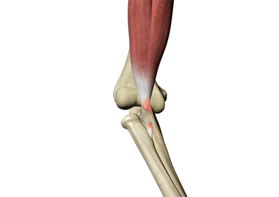 Distal Biceps Avulsion