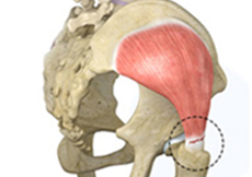 Gluteal Tendon Repair