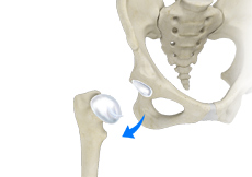Picture of hip dislocation