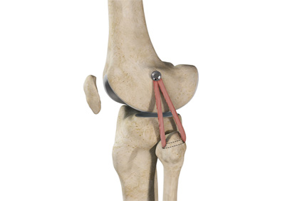 LCL Reconstruction