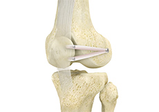 Picture of Medial Patellofemoral Ligament Reconstruction