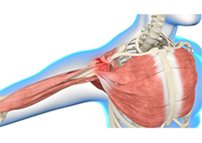 Shoulder Impingement