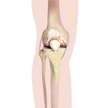 Knee Arthritis