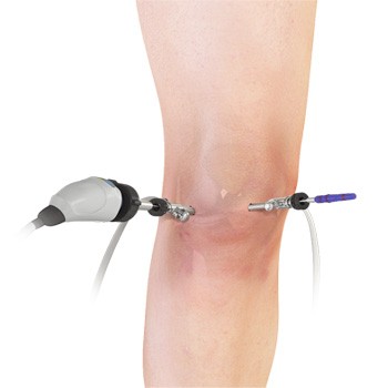 knee arthroscopy