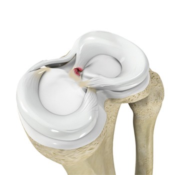 Meniscal Root Tear