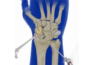 Arthroscopic Partial Wrist Fusion