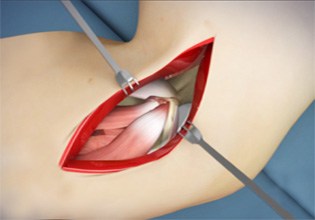 Elbow Surgery