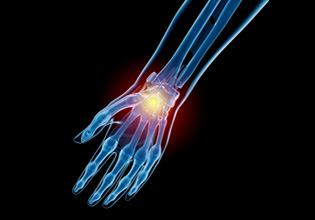 Sports Injuries of the Hand and Wrist