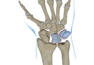 Triquetrolunate Instability