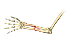 Adult Forearm Fractures