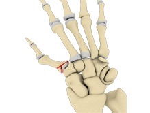 Bennett&acirc;s Fracture