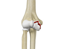 Distal Humerus Fractures of the Elbow