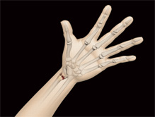 Distal Radius Fracture