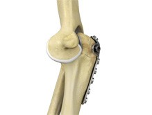 Elbow Fracture Reconstruction